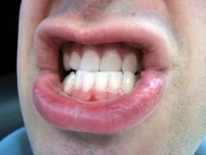 gums